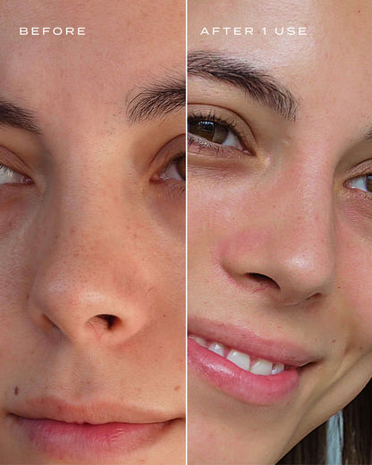 Vue -Patchs pour le Nez