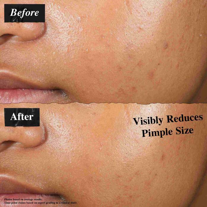 Avant/ Après avec notre Patch Liquide Invisible Anti-Imperfections
