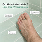 Pied avec la peau qui pèle entre les orteils, signes d’une mycose