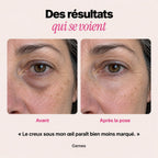 Avant et après, creux sous l’œil