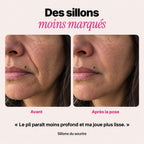 Avant et après, sillon du sourire